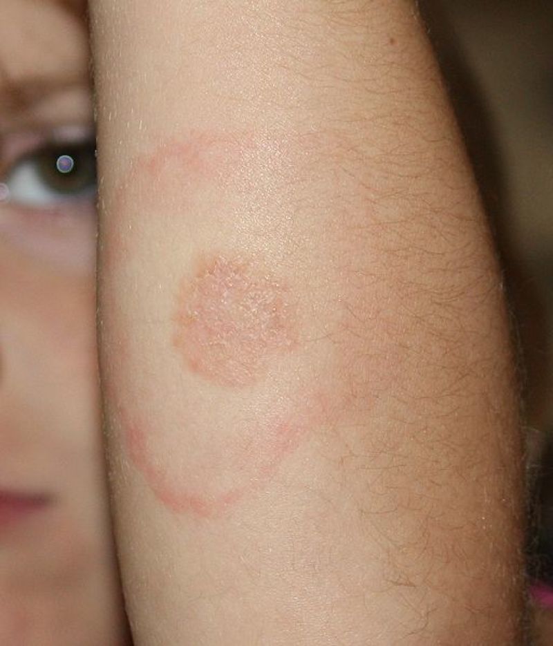 Lyme Disease